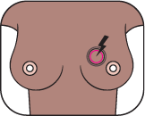 Breast with highlighted area indicating pain or tenderness