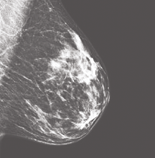 Mammogram image showing a clearer view of breast tissue with defined structures and brighter dense areas
