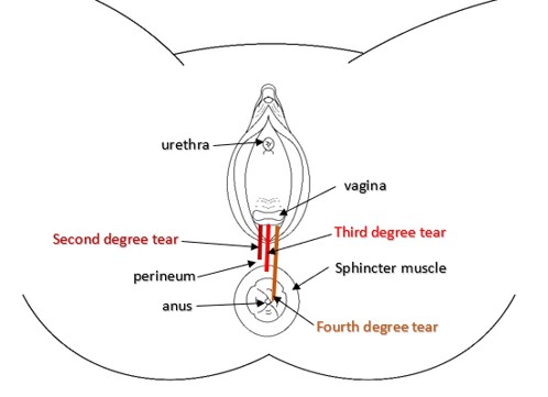 illustration of vagina and anus with different captions on degree of tear in red, black and brown font