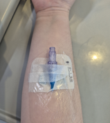 Close-up of a forearm with a purple peripheral intravenous (IV) cannula inserted and secured using transparent film dressing and medical tape, resting on a clinical surface.