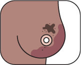 Breast showing reddened and discoloured skin with a rash-like appearance