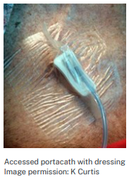 Close-up of an accessed portacath in the upper chest area, connected to tubing and covered with a transparent dressing to secure the access site.