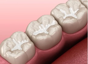 Molar teeths with fissure sealant