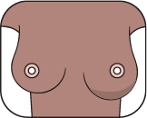 Breast showing swelling