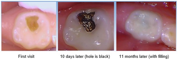 Process of filling silver fluoride in damaged teeth