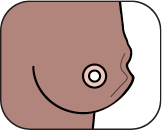 Breast showing change in size or shape distortion