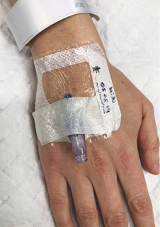 A cannula with a purple hub is inserted on the back of a hand and held in place with transparent dressing and white tape. A white wristband is visible near the wrist