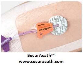 Close-up of a SecurAcath catheter securement device attached to the skin and covered by a transparent dressing, with a vascular access catheter extending from the insertion site.
