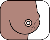 Breast showing puckering and dimpling of the skin