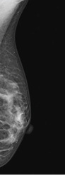 Mammogram image showing a breast implant pushed back to reveal more breast tissue