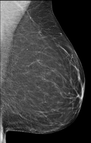 Diagnostic mammogram image displaying breast tissue in profile, with varying densities visible throughout the breast for screening and evaluation purposes.