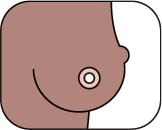 Breast showing a visible lump