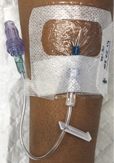 A cannula is inserted on a forearm and connected to a clear extension tube with a capped port. The insertion site is covered with a transparent dressing and secured with white tape.