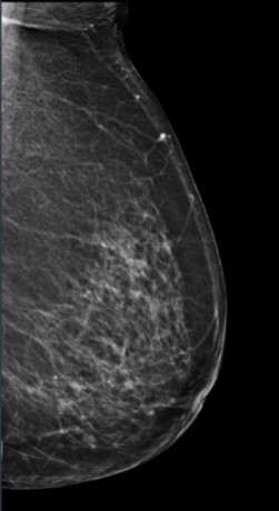 Diagnostic mammogram image displaying a breast in profile, with varying tissue densities visible throughout the breast for clinical screening and evaluation purposes