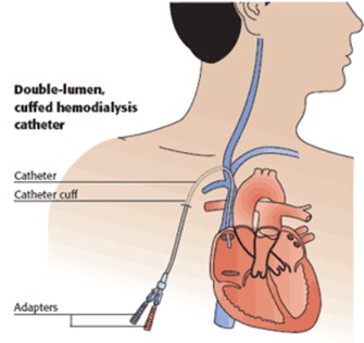 Diagram showing where a CVC catheter enters the heart