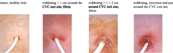 Different CVC insertion infection stages