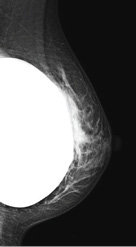 Mammogram image showing a breast implant obscuring part of the breast tissue