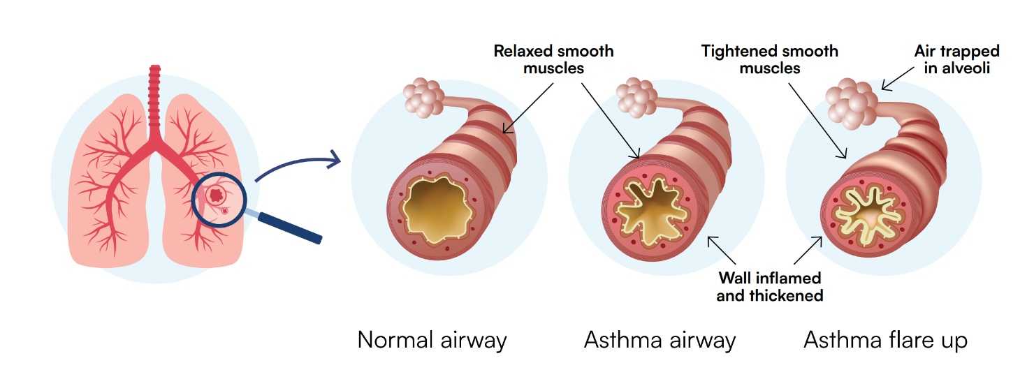 Diagram showing lungs and three airway stages: a normal airway with open space and relaxed muscles, an asthma airway with inflamed and thickened walls and tightened muscles, and an asthma flare-up with severely narrowed airway and mucus or air trapped in the alveoli.
