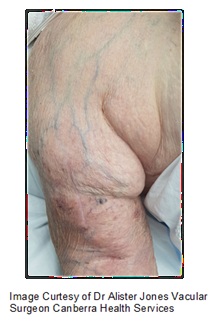 Arm showing central vein stenosis