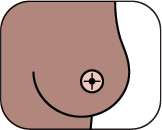 Breast showing nipple inversion