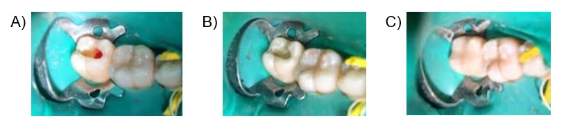 Different stages of pulpotomy