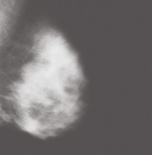 Mammogram image showing an unclear white mass with blurred edges